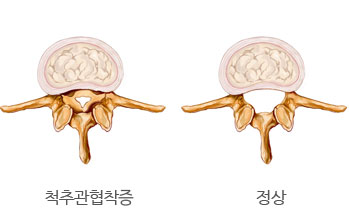 척추관협착증