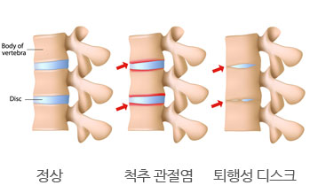 퇴행성디스크