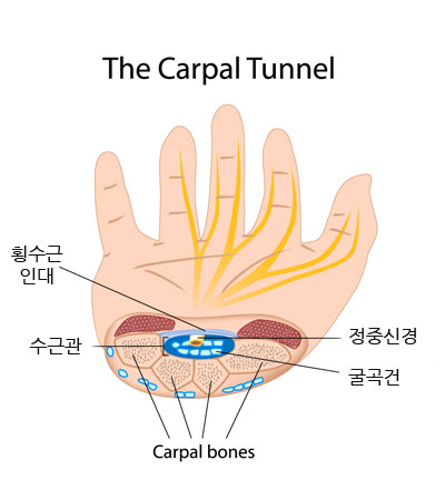 손목터널 증후군
