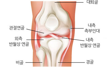 무릎인대