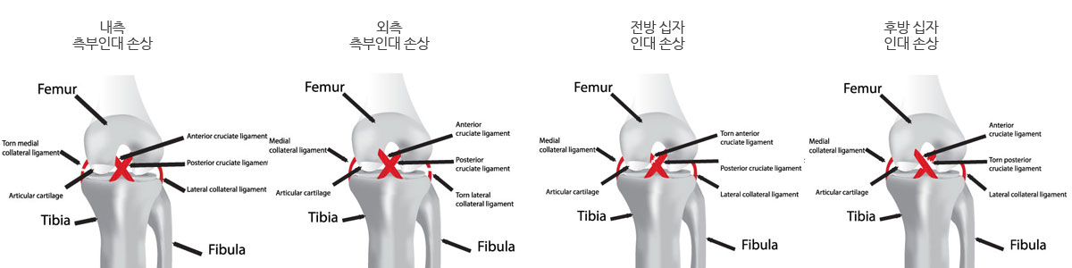 무릎인대 손상