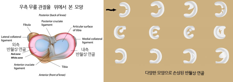 무릎 반월상 연골 손상