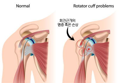 회전근개손상