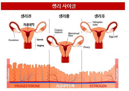 자궁내막증
