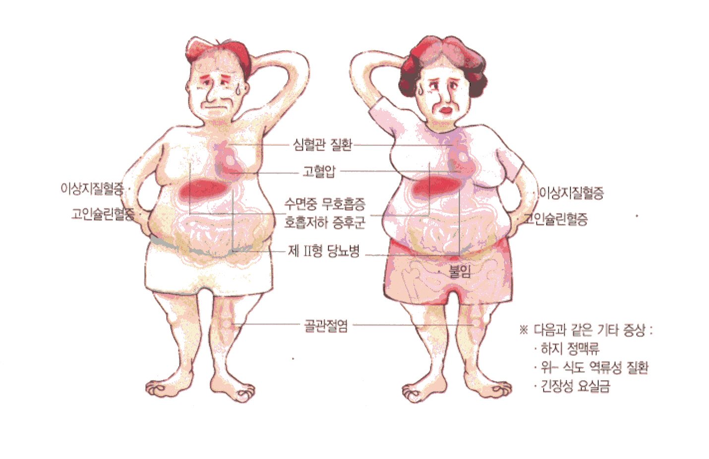 비만은 질병입니다