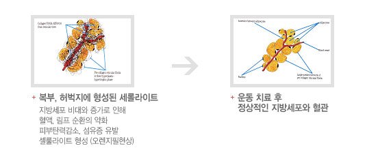 비만클리닉  DIET 운동 2