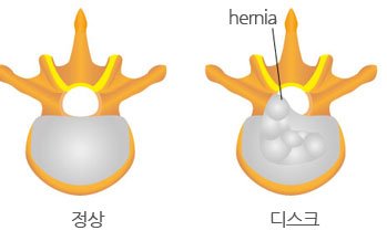 통증클리닉 척추질환의 한방치료 5