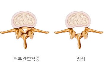 통증클리닉 척추질환의 한방치료 6