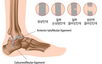 통증클리닉 각종 염좌 2