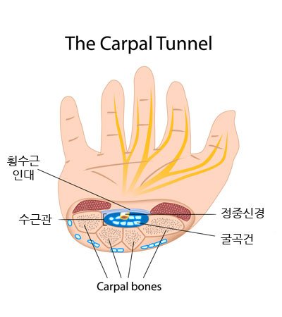통증클리닉  손목터널 증후군