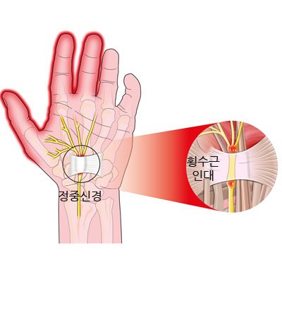 통증클리닉  손목터널 증후군 2