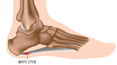 통증클리닉 발바닥 근막염