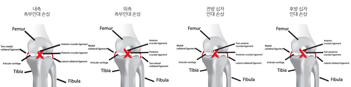 통증클리닉  무릎 질환 4