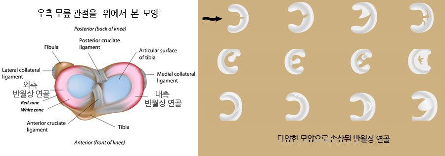통증클리닉  무릎 질환 5