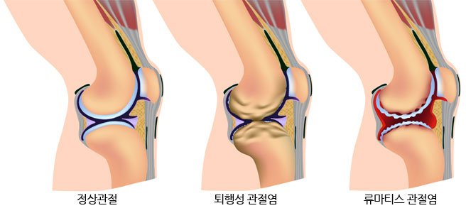 통증클리닉  무릎 질환 6