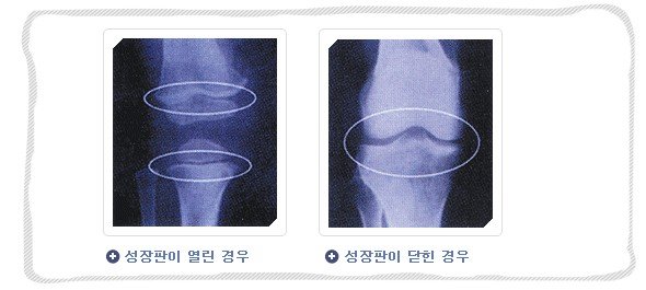 성장클리닉 성장판과 성장 4