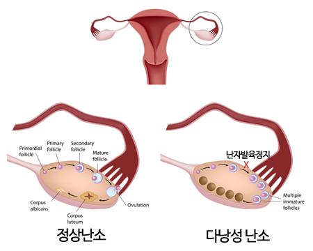 여성클리닉 생리불순,다낭성난소