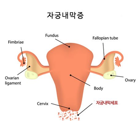 여성클리닉 자궁내막증
