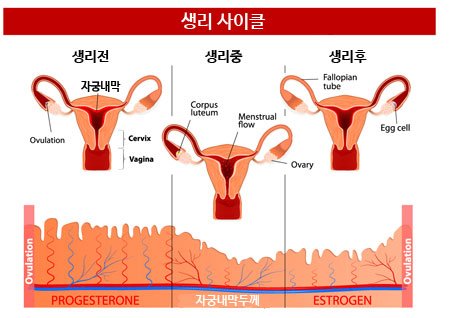 여성클리닉 자궁내막증 2