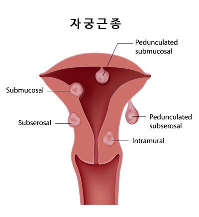 여성클리닉 자궁근종