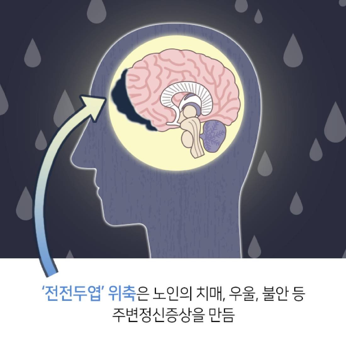 노인성 치매의 한약 치료 2