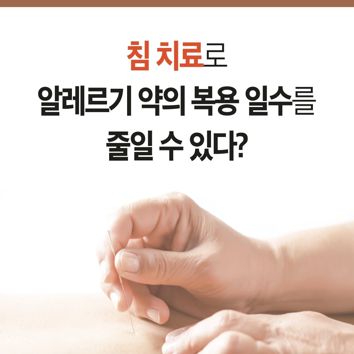 침 치료로 알레르기 비염 환자의 항히스타민제 사용을 감소 시킨다.